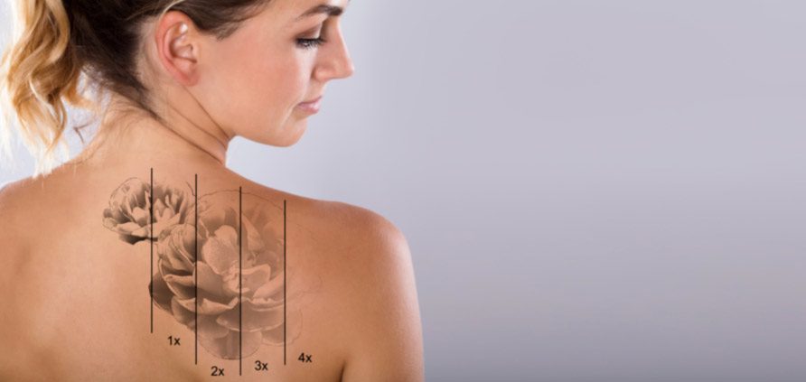La rimozione dei tatuaggi