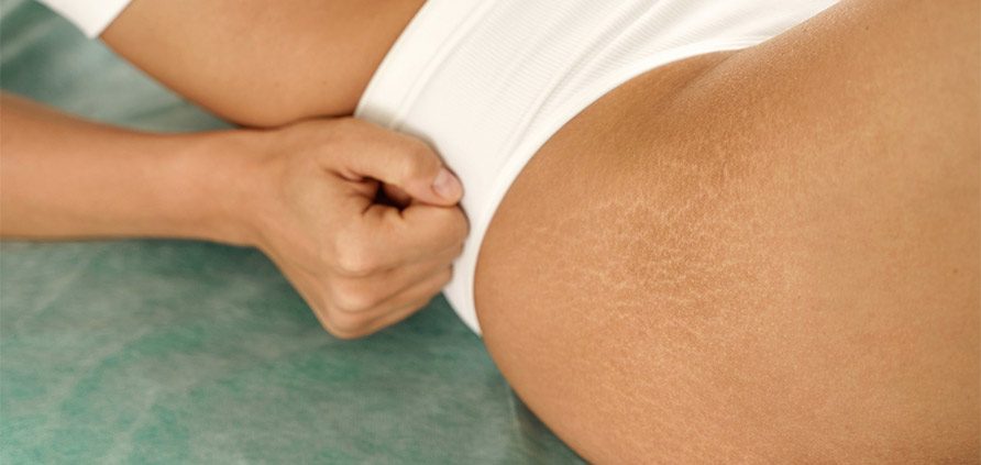 Rimozione delle smagliature