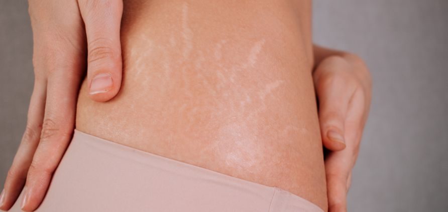 Rimozione-smagliature-metodi-combinati-Poliambulatorio-Agresti